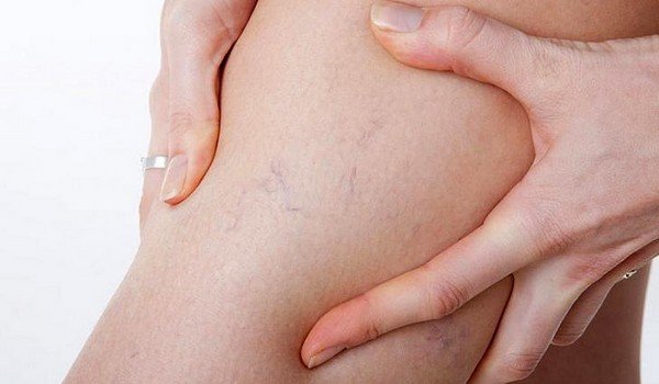 Киста в молочной железе-народные методы лечения
