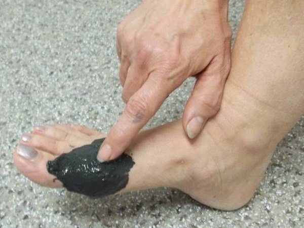 Лечение косточки на ноге у большого пальца народными средствами