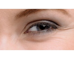Как предотвратить мелкие морщинки вокруг глаз thumbnail