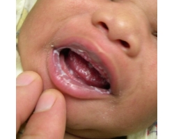 Лечение молочницы у младенцев в домашних условиях